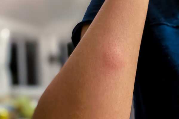 Wie man Mückenstiche so schnell wie möglich loswerden